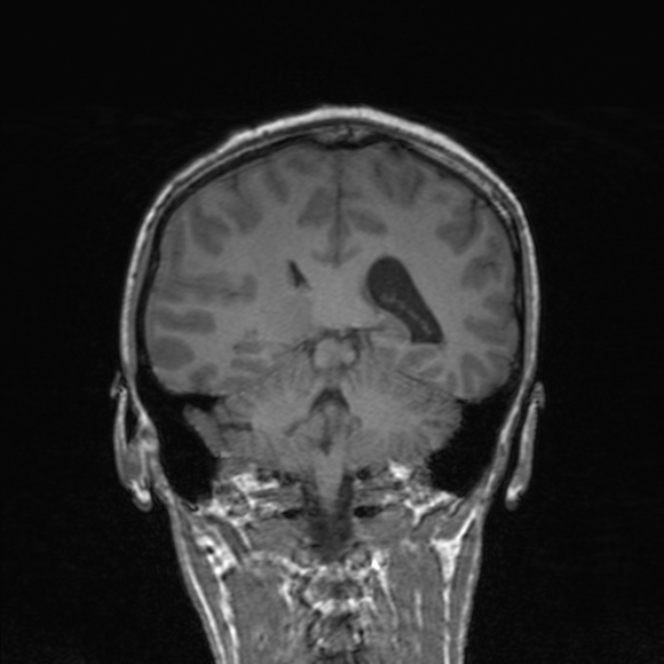 Cerebral abscess (Radiopaedia 24212-24478 Coronal T1 136).jpg