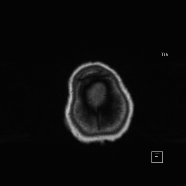 Cerebral abscess (Radiopaedia 26111-26247 Axial T1 52).jpg