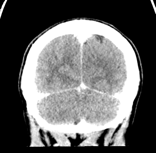 Cerebral abscess (Radiopaedia 60342-68008 Coronal C+ delayed 55).png