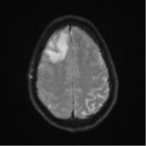 Cerebral abscess (Radiopaedia 60342-68009 Axial DWI 28).png