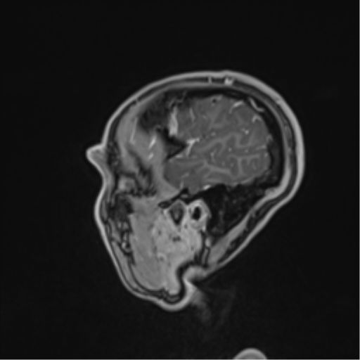 File:Cerebral abscess (Radiopaedia 60342-68009 J 49).png