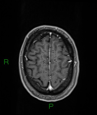 Cerebral abscess and subdural empyema (Radiopaedia 84436-99779 Axial T1 C+ 18).jpg