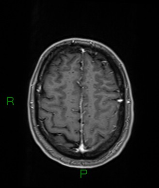 Cerebral abscess and subdural empyema (Radiopaedia 84436-99779 Axial T1 C+ 21).jpg