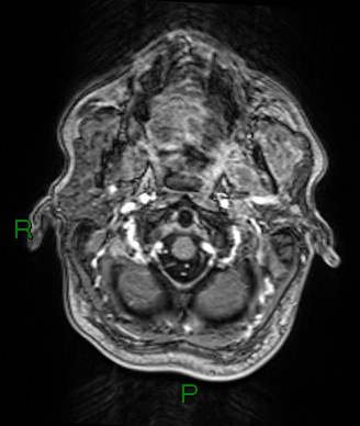 File:Cerebral abscess and subdural empyema (Radiopaedia 84436-99779 Axial T1 C+ 80).jpg