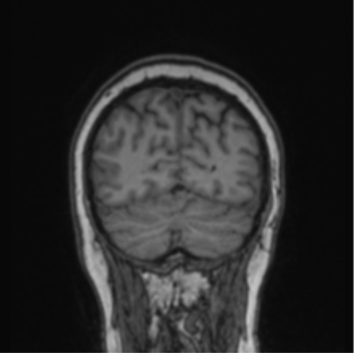 File:Cerebral abscess from pulmonary arteriovenous malformation (Radiopaedia 86275-102291 Coronal T1 21).png