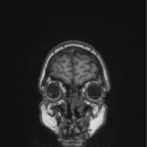 Cerebral abscess from pulmonary arteriovenous malformation (Radiopaedia 86275-102291 Coronal T1 81).png