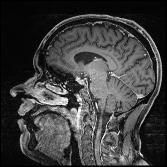 Cerebral abscess with ventriculitis (Radiopaedia 78965-91878 Sagittal T1 C+ 100).jpg