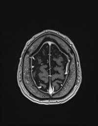 Cerebral amyloid angiopathy-related inflammation (Radiopaedia 58270-65377 Axial T1 C+ fat sat 135).jpg