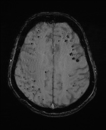 Cerebral amyloid angiopathy-related inflammation (Radiopaedia 74836-85849 Axial SWI 50).jpg