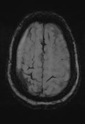 File:Cerebral amyloid angiopathy (Radiopaedia 29129-29518 Axial SWI MPR 30).jpg
