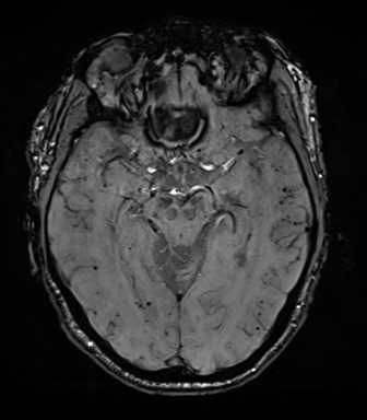 File:Cerebral amyloid angiopathy (Radiopaedia 46082-50433 Axial SWI 34).png