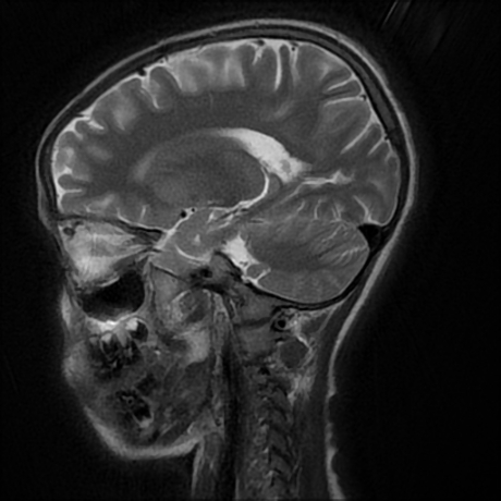 File:Cerebral and spinal tuberculosis (Radiopaedia 90489-107837 Sagittal T2 8).jpg