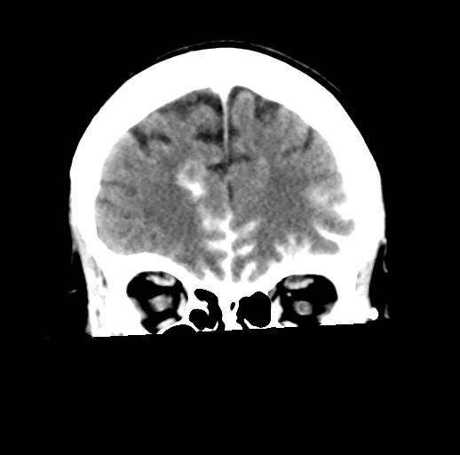 File:Cerebral aneurysm with rupture (Radiopaedia 29933-30460 Coronal non-contrast 9).jpg