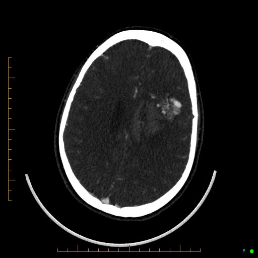 Cerebral arteriovenous malformation (AVM) (Radiopaedia 78162-90706 Axial CTA 184).jpg
