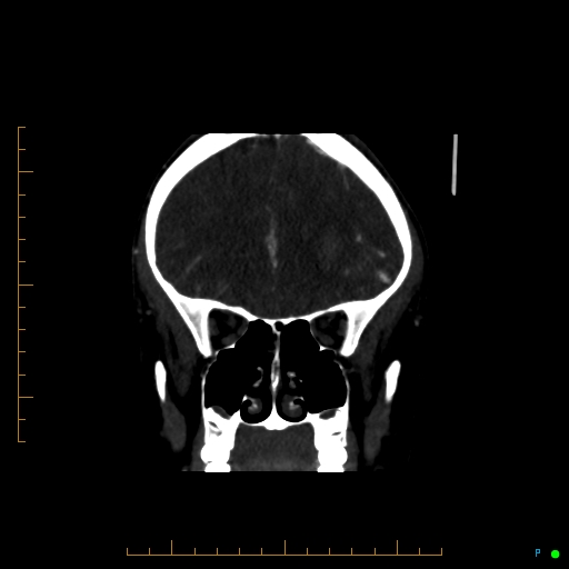 Cerebral arteriovenous malformation (AVM) (Radiopaedia 78162-90706 Coronal CTA 74).jpg