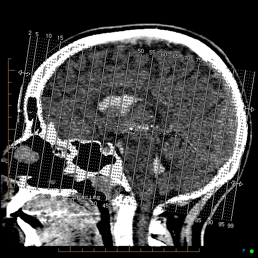 Cerebral arteriovenous malformation (AVM) (Radiopaedia 78162-90706 Coronal non-contrast 2).jpg