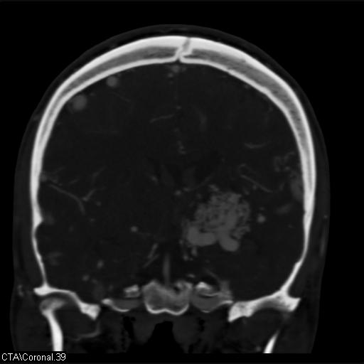 Cerebral arteriovenous malformation (Radiopaedia 28518-28759 C 39).jpg