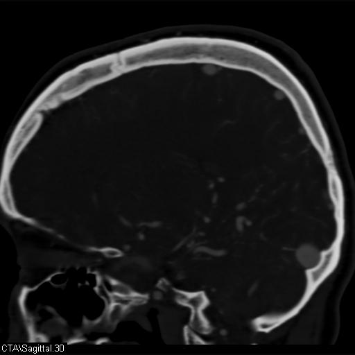 Cerebral arteriovenous malformation (Radiopaedia 28518-28759 D 27).jpg