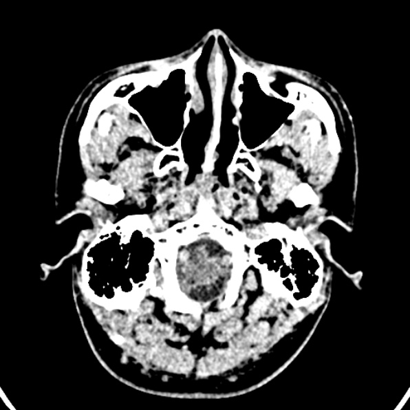 Cerebral arteriovenous malformation (Radiopaedia 37182-39012 Axial non-contrast 3).jpg
