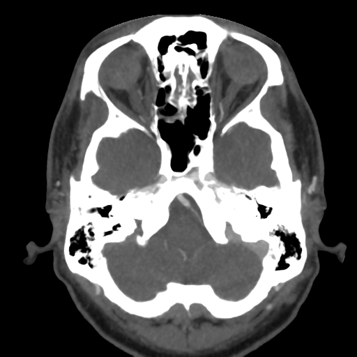 Cerebral arteriovenous malformation (Radiopaedia 39259-41505 AX CEREBRAL CTA 12).png
