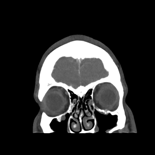 Cerebral arteriovenous malformation (Radiopaedia 39259-41505 E 8).png