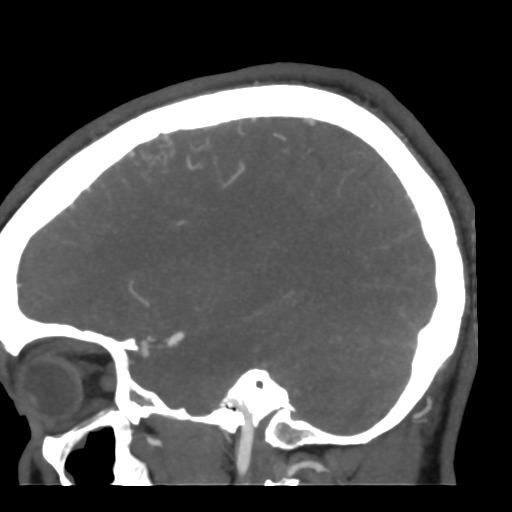 Cerebral arteriovenous malformation (Radiopaedia 39259-41505 Sagittal 19).png