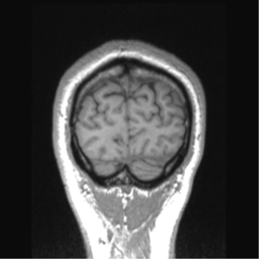 Cerebral arteriovenous malformation (Radiopaedia 39259-41506 Coronal T1 12).png