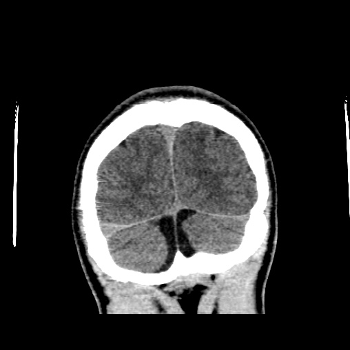 File:Cerebral arteriovenous malformation (Radiopaedia 61964-70028 Coronal non-contrast 54).jpg