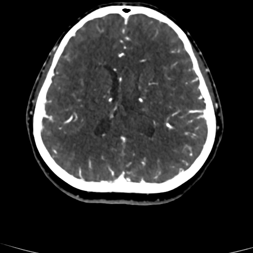 Cerebral arteriovenous malformation (Radiopaedia 73830-84645 Axial C+ delayed 37).jpg