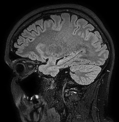 Cerebral arteriovenous malformation (Radiopaedia 74411-85654 Sagittal FLAIR 37).jpg