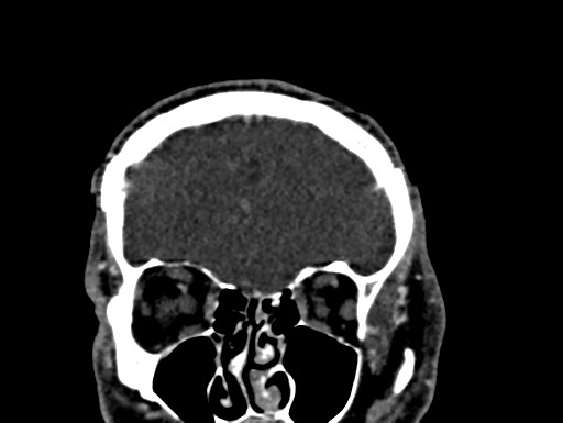 Cerebral arteriovenous malformation (Radiopaedia 78188-90746 Coronal C+ delayed 18).jpg