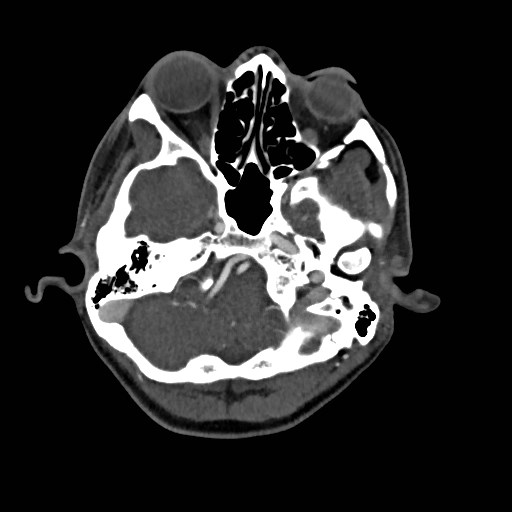 File:Cerebral arteriovenous malformation (Radiopaedia 79677-92888 A 5).jpg