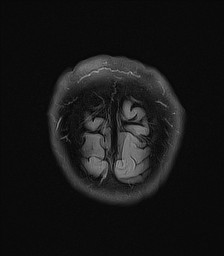 File:Cerebral arteriovenous malformation (Radiopaedia 84015-99245 Coronal FLAIR 33).jpg