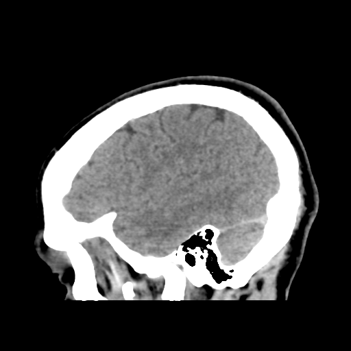 Cerebral arteriovenous malformation (Spetzler-Martin grade 2) (Radiopaedia 41262-44076 A 49).png
