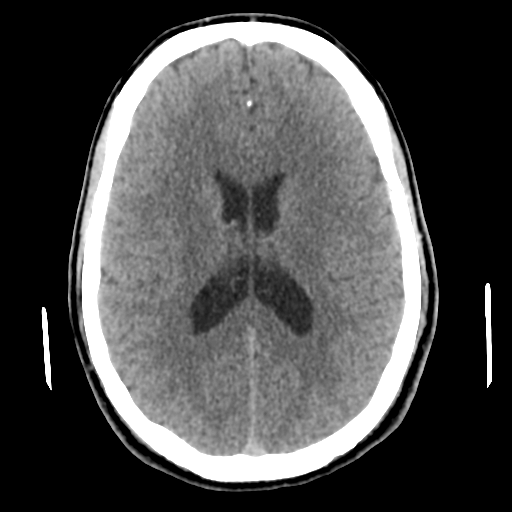 Cerebral arteriovenous malformation (Spetzler-Martin grade 2) (Radiopaedia 41262-44076 Axial non-contrast 33).png