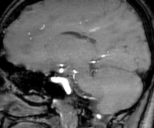 Cerebral arteriovenous malformation at posterior body of corpus callosum (Radiopaedia 74111-84925 J 158).jpg