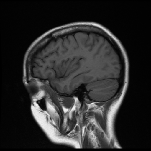 File:Cerebral autosomal dominant arteriopathy with subcortical infarcts and leukoencephalopathy (CADASIL) (Radiopaedia 41018-43768 Sagittal T1 5).png