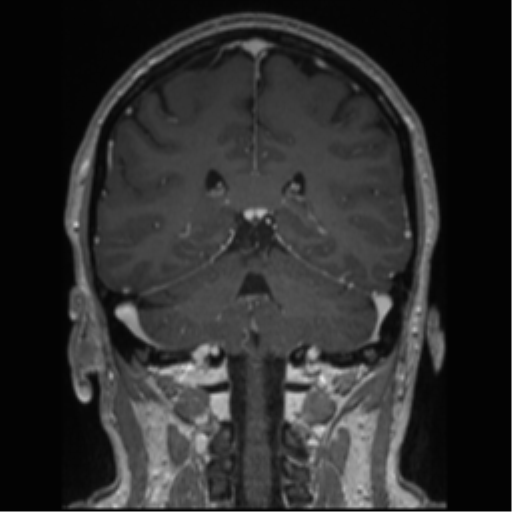 Cerebral cavernoma and development venous anomaly (Radiopaedia 37603-39482 Coronal T1 C+ 37).png