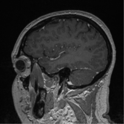 Cerebral cavernoma and development venous anomaly (Radiopaedia 37603-39482 Sagittal T1 C+ 26).png
