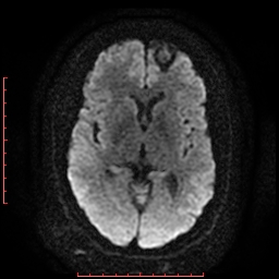 File:Cerebral cavernous malformation (Radiopaedia 26177-26306 Axial DWI 11).jpg