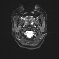 File:Cerebral cavernous venous malformation (Radiopaedia 70008-80021 Axial DWI 1).jpg