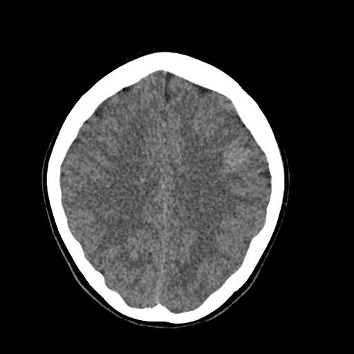 File:Cerebral cavernous venous malformation (Radiopaedia 70008-80022 Axial non-contrast 36).jpg