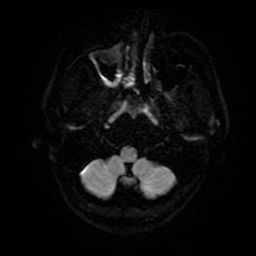 Cerebral cavernous venous malformation (Zabramski type II) (Radiopaedia 85511-101198 Axial DWI 5).jpg