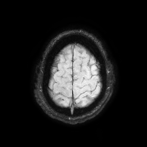 Cerebral cavernous venous malformation (Zabramski type II) (Radiopaedia 85511-101198 Axial SWI 103).jpg