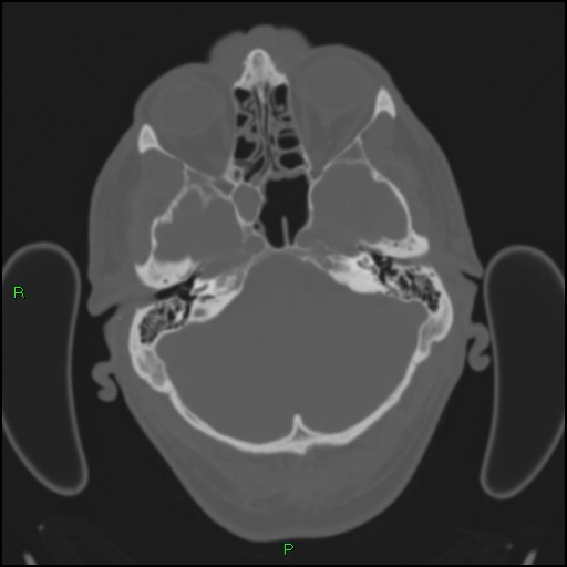 File:Cerebral contusions (Radiopaedia 33868-35039 Axial bone window 41).jpg