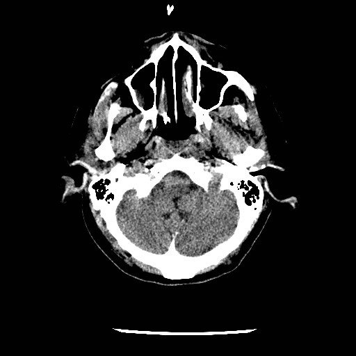 File:Cerebral edema (evolution in time) (Radiopaedia 19418-19441 non-contrast 14).jpg