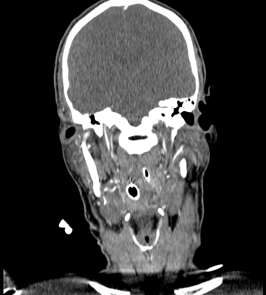 Cerebral edema in an overdose patient (Radiopaedia 72005-82539 B 61).jpg