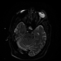 File:Cerebral embolic infarcts (embolic shower) (Radiopaedia 49837-55108 Axial DWI 33).jpg