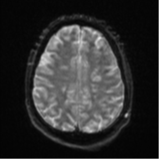 Cerebral embolic infarcts (embolic shower) (Radiopaedia 57395-64342 Axial DWI 26).png