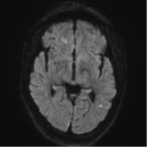 Cerebral embolic infarcts (embolic shower) (Radiopaedia 57395-64342 Axial DWI 53).png